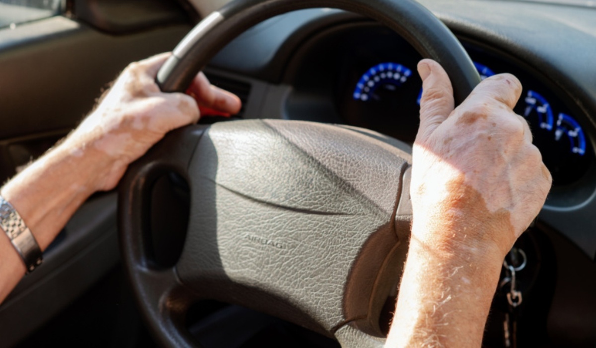 Почему появляется витилиго и как его лечить 