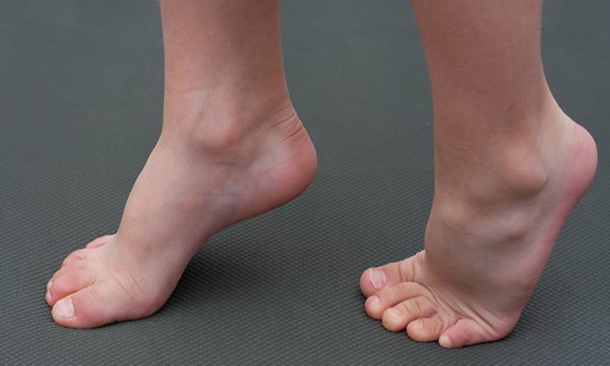 Плоскостопие встречается у половины людей — травматолог объяснил, почему это происходит