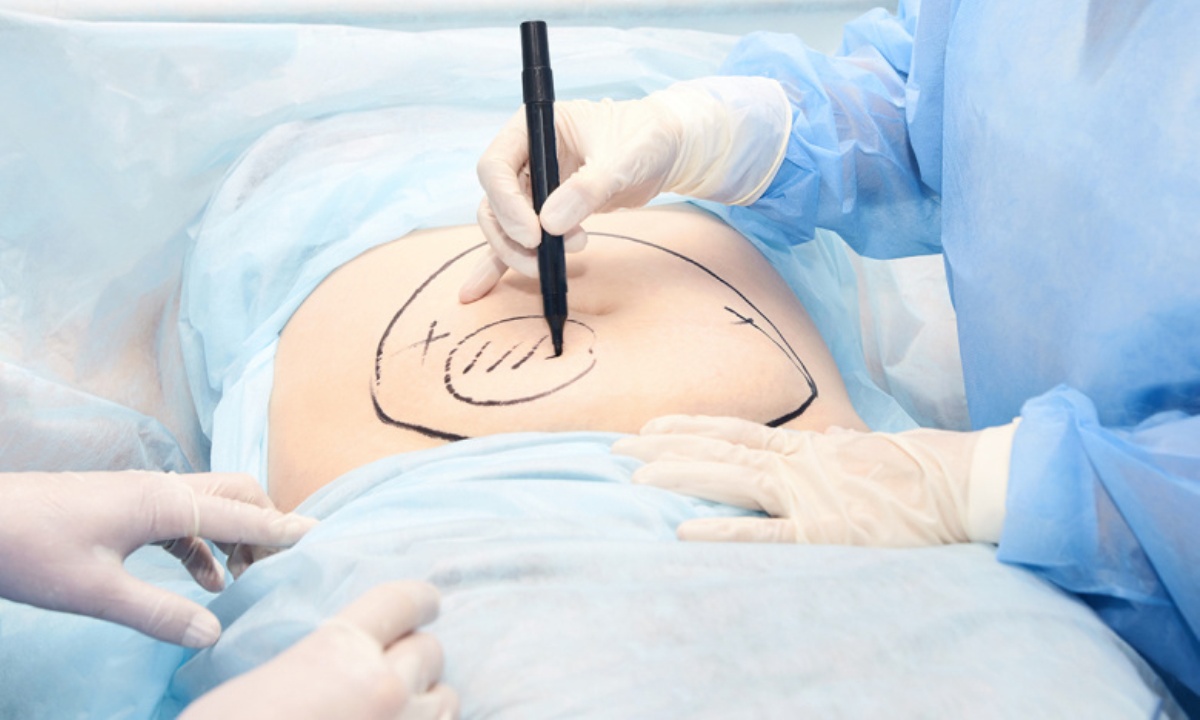 Может ли липосакция избавить от целлюлита