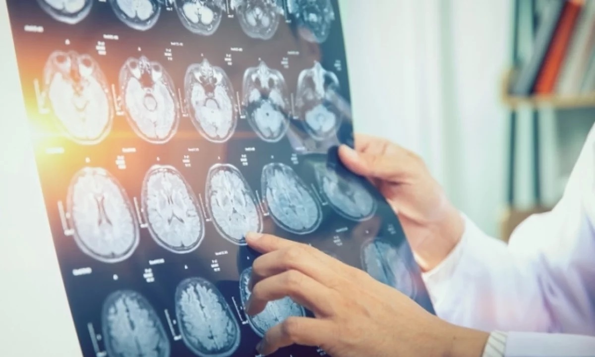 Может ли стресс стать причиной микроинсульта