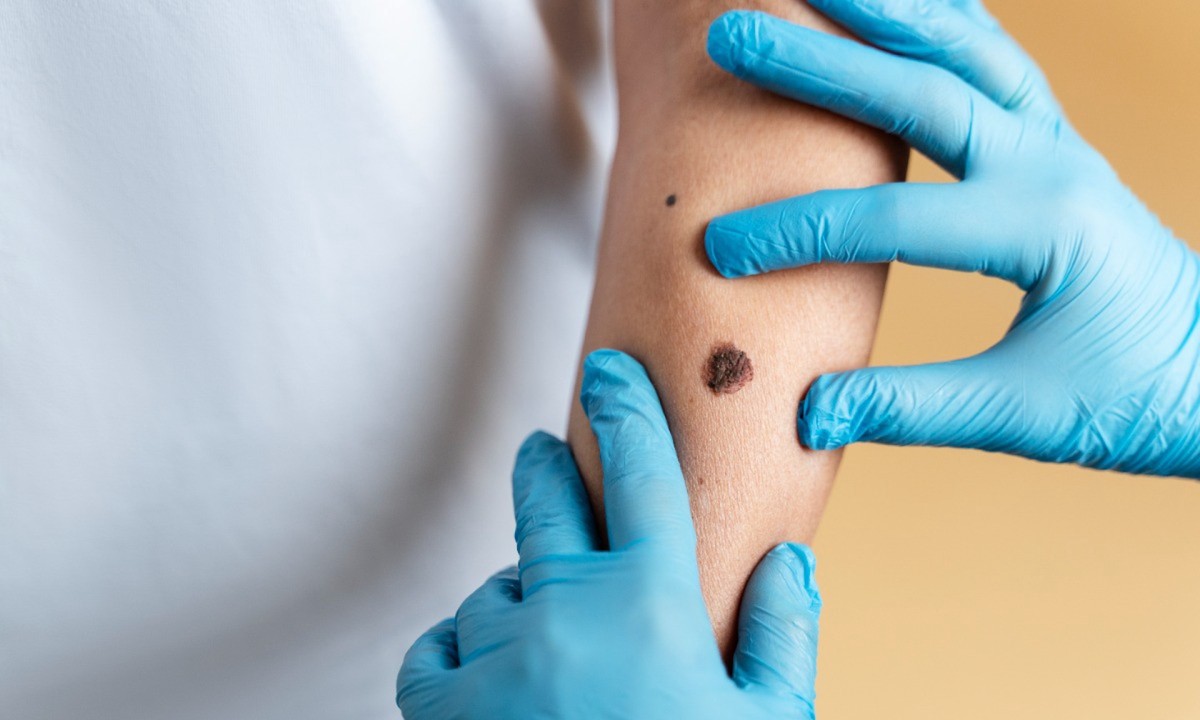 Что делать в случае травмирования родинки