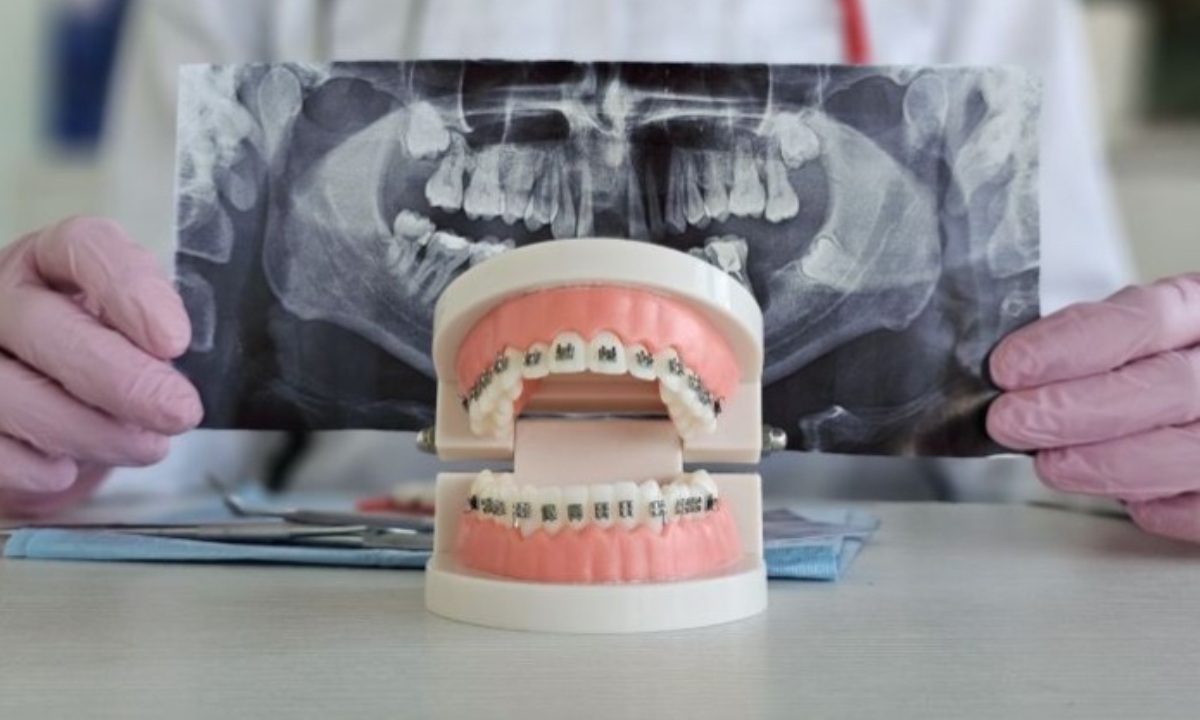 Какие последствия несут неправильно установленные брекеты