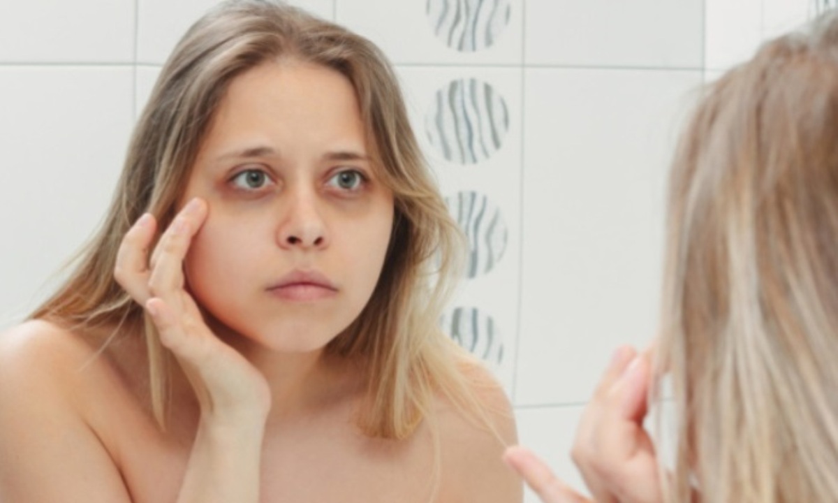 О чём говорят тёмные круги под глазами?