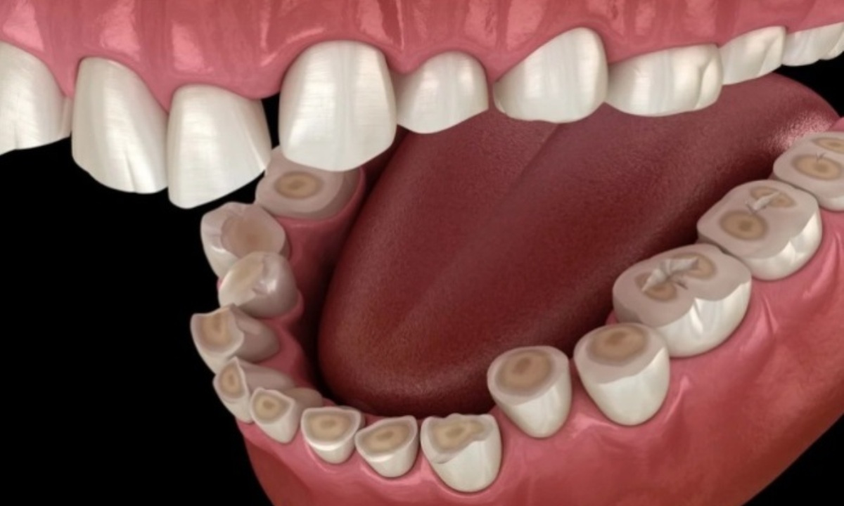 Какую скрытую опасность может нести постепенное стирание зубов