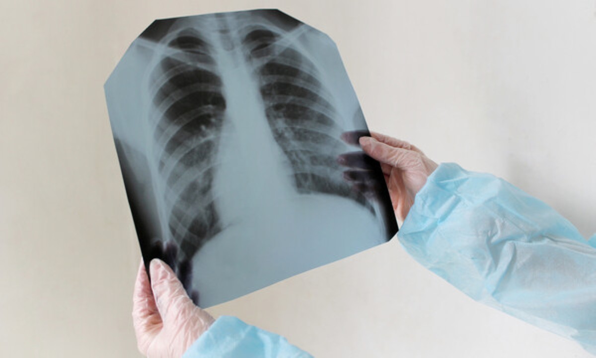 Как туберкулез негативно влияет на состояние ума