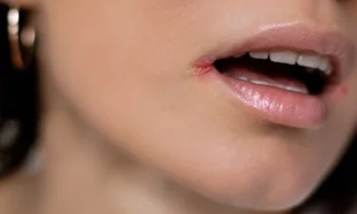 Почему появляются заеды в уголках рта?