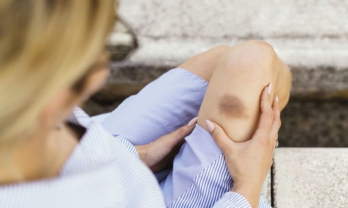 Почему синяки на теле появляются даже от лёгкого прикосновения