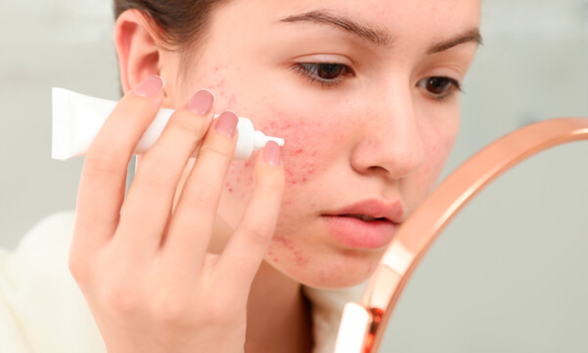 Когда прыщи говорят о серьезных проблемах со здоровьем