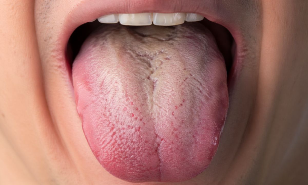 Врач объяснил, о чём может говорить налёт на языке