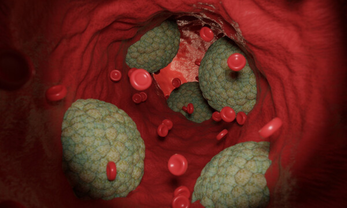 Какая диета помогает в профилактике атеросклероза