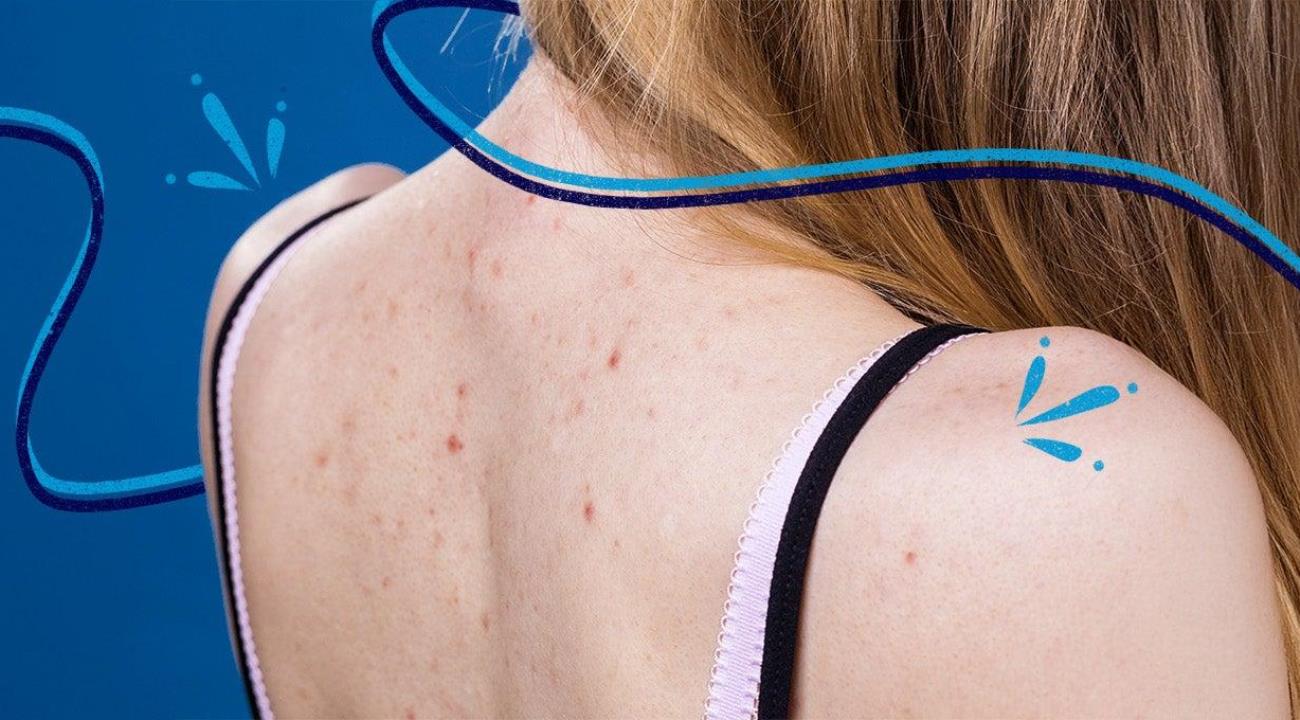 Одна ошибка с прыщами на спине может оставить следы на годы
